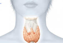 Tips to Manage Hypothyroidism
